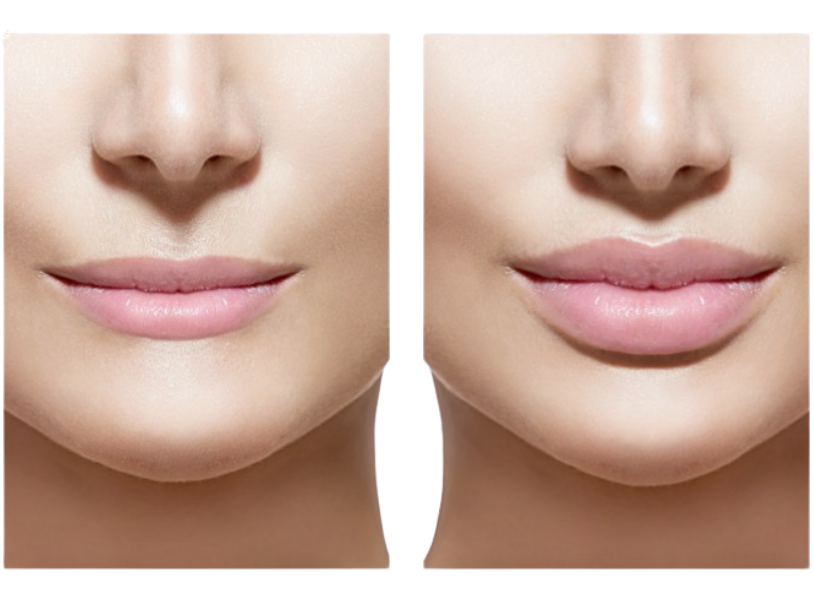 LipsBoost. Comprueba el antes y el después en la evolución de tus labios. Aumenta tus labios de manera natural